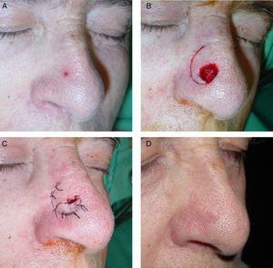 A, Basal cell carcinoma on the lateral surface of the nose. B, Flap with a superior pedicle dissected in the subcutaneous plane. C, The flap was rotated perpendicular to the dorsum of the nose. D, Appearance at 8 months.