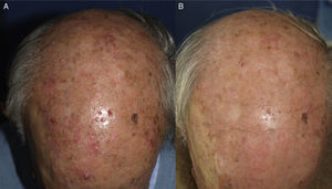 Man with multiple actinic keratoses and field cancerization on the scalp. A) Before treatment and B) 3 mo after daylight photodynamic therapy with methyl aminolevulinate.