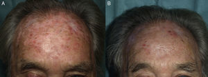 Man with grade 2 and grade 3 actinic keratosis lesions on the forehead; the lesions were treated previously with cryotherapy. A) Prior to daylight photodynamic therapy (PDT), during treatment with hydroxyurea; and B) 3 months after methyl aminolevulinate daylight PDT.