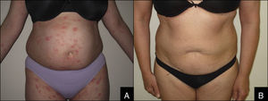 Chronic cutaneous lichenoid GVHD before (A) and after (B) phototherapy.