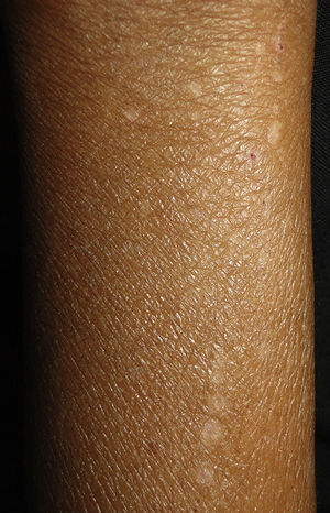 Xerotic skin with excoriations marks secondary to renal pruritus.