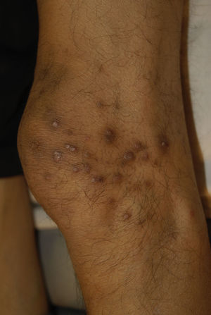 Acquired perforating dermatosis. Pigmented and umbilicated dome shape papules with scaling centre. Image supplied by National Institute of Medical Science and Nutrition Salvador Zubiran.