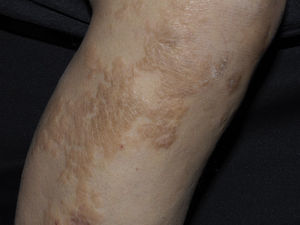 Nephrogenic systemic fibrosis. Indurated hyperchromic plaques with orange peel and woody appearance. Image supplied by National Institute of Medical Science and Nutrition Salvador Zubiran.