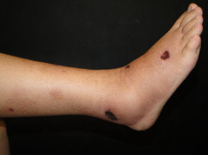 Calciphylaxis. Ulcers covered with black eschar.