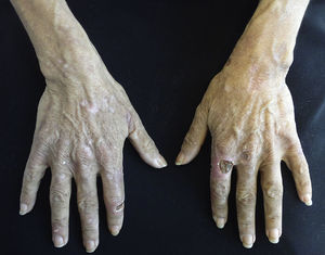 Porphyria cutanea tarda. Erosions and crusts on the back of the hands. Image supplied by National Institute of Medical Science and Nutrition Salvador Zubiran.