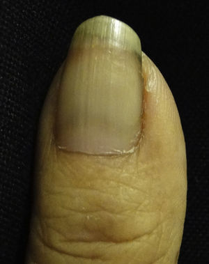 Half and Half nail. A white proximal area and a red-brown distal area are observed.