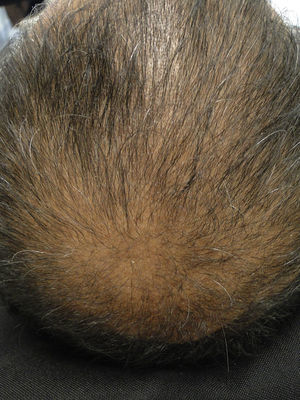 Diffuse alopecia.