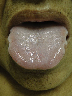 Macroglossia. An enlarged tongue framed in its edge by teeth, pallor is also observed in the perioral skin.