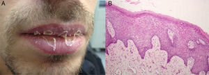 (a) Whitish scales on the vermilion borders of both lips in patient 2 before treatment. (b) Mounds of parakeratosis and hypogranulosis, acanthosis, and dilated, vertically elongated papillary vessels (hematoxylin-eosin, original magnification ×20).