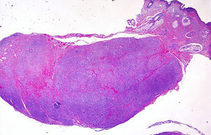 Histopathology of the melanoma nodule removed (hematoxylin-eosin, original magnification ×1).
