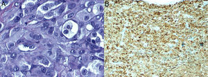 A, Cell pleomorphism in the area corresponding to the melanoma; note the mitotic figure in the center (hematoxylin-eosin, original magnification ×60). B, Intense and diffuse positive cytoplasmic expression of MelanA (×40).