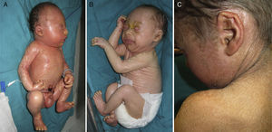 Case 4. A, Collodion baby phenotype at 24hours old. B, Marked ectropion at 3 weeks of age. C, Lamellar ichthyosis phenotype at 4 years of age.