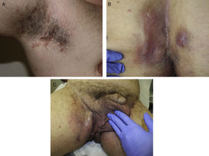 Grade III hidradenitis suppurativa in a 36-year-old man. A, Indurated, painful linear lesions in the armpit. B, Inflammatory nodules and abscesses leaking pus on the buttocks. B, Confluent abscesses in the right groin area.