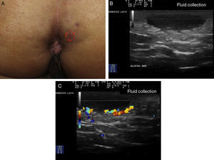 Hidradenitis suppurativa. A, Clinical image of apparently insignificant nodular lesion. B, Ultrasound image showing a large underlying fluid collection. C, High inflammatory activity evidenced by Doppler ultrasound.