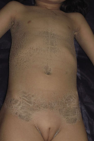 Body distribution of the lamellar scales outlining the form of a woman's bathing suit, with sparing of the limbs and of the central area of the abdomen.
