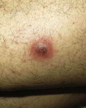 A fluctuating violaceous nodule on the left thigh.