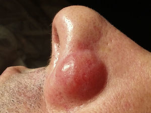 A single nodular lesion of 2.5cm diameter on the nasal ala.
