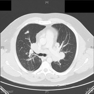 High resolution computed tomography, axial cuts: Multiple nodules forming masses were observed in the mediastinum, at both hila, and in the left supraclavicular fossa, in addition to nodular pulmonary involvement.