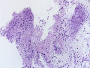 Noncaseating chronic granulomatous inflammation in the transbronchial biopsy. Hematoxylin-eosin, original magnification x200.