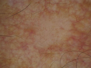 Dermoscopy findings for case 1. Short, fine, poorly branching telangiectases on a pearly background.