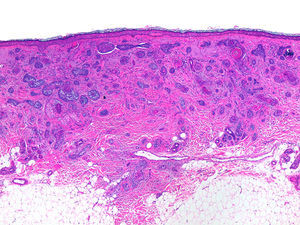 Basal cell nests in dense stroma in the dermis (hematoxylin-eosin, ×40).