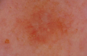 Dermoscopy findings for case 2. Poorly branching crown vessels with white striae and milia pseudocysts.