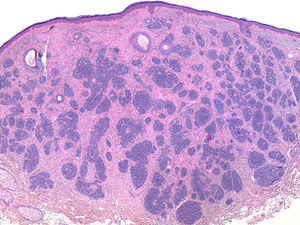 Nests of basal cells in dense stroma with a high fibroblast count (hematoxylin-eosin, ×40).