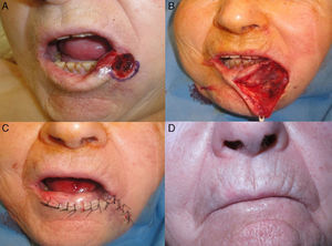 A, Partial thickness defect after 2 stages of Mohs micrographic surgery. B, After preanesthetic marking of the Klein line, essential to avoid subsequent distortion, the cutaneous lip was dissected, and the original defect was modified using an inferior triangle in order to adapt it to the lines of expression. C, Immediate postoperative appearance. D, Nine months after surgery.