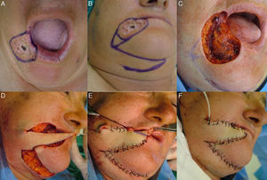 A, Basal cell carcinoma that affected the melolabiomental skinfold and the vermillion at the labial commissure. B, Design of the transposition flap with an inferior base. C, Partial thickness skin and mucosal defect created by excision of the tumor with a surgical margin. D, Incision of the flap in the same plane and transposition. E, Suture and excision of the excess skin. The mucosa was advanced (not visible in the image) in order to reconstruct the vermillion. F, Immediate postoperative appearance.