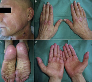 A, Erythematous-violaceous rash on the face and neck, which spares areas not exposed to sunlight, such as the lower eyelids and the submental area; alopecia due to chemotherapy also observed. B, Gottron papules on the metacarpophalangeal and interphalangeal joints. C, Edema in the soles of both feet. D, Swollen palms and sausage fingers.