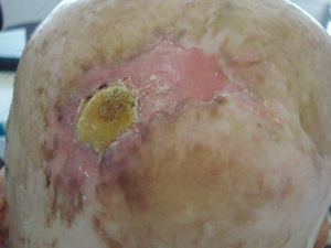 Squamous cell carcinoma of the scalp, formed on the scars of a childhood burn.