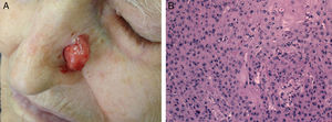 A, Poorly differentiated squamous cell carcinoma on the lateral nasal wall; and B, Histologic features of the same tumor, hematoxylin-eosin (original magnification, ×200).
