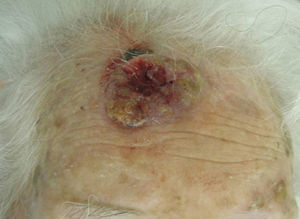 Large squamous cell carcinoma on the forehead.