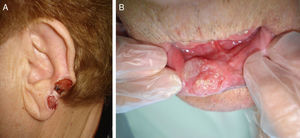 Squamous cell carcinomas in locations considered high risk. A, External ear tumor. B, Lower lip tumor.