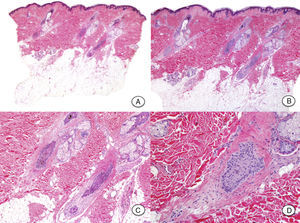 Histopathology after staining with hematoxylin and eosin. A, No hair follicles are visible in the hypodermis. B, The dermis is spared and presents retracted hair follicles with no inflammatory infiltrate. C, The outer root sheath of the retracted hair follicles has an undulating, corrugated morphology, typical of catagen phase. D, Characteristic fibrous stela of follicles in catagen.