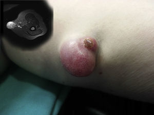 A, Cutaneous component with a dome-like pedunculated vascular appearance and ulceration at the superior pole. B, MRI showing an exophytic multilobulated mass with a blood supply from and drainage to the basilic vein (arrow).