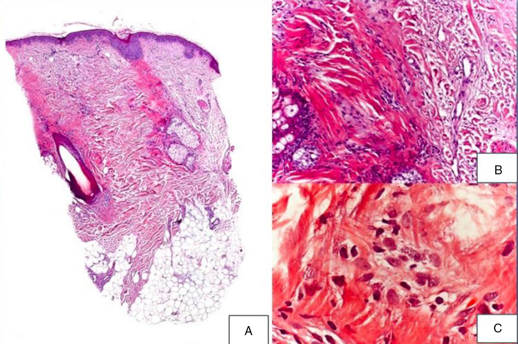 Mast Cells and Scarring Alopecia: Is There a Clear Pathophysiological ...