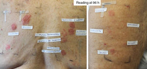Patient diagnosed with Hailey-Hailey disease sensitized to all 3 groups of corticosteroids. The standard series revealed positive results for budesonide, tixocortol pivalate, and hydrocortisone 17-butyrate. A reading at 96hours with the patients’ own corticosteroids revealed the following results: Adventan (methylprednisolone) +++, Elocom (mometasone furoate) +++, Clovate (clobetasol propionate) ++, Diproderm (betamethasone 17,21-dipropionate)+Diprogenta (betamethasone)+Fucibet (fusidic acid and betamethasone valerate)+Peitel (prednicarbate) ++. With the corticosteroid series the results were as follows: clobetasol propionate +++, dexamethasone 21-phosphate +++, betamethasone 17-valerate ++, triamcinolone acetonide ++, and alclometasone dipropionate ++.