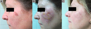 Partial Response to ingenol mebutate following treatment that was not completed due to a type iv local reaction. A, Non-hyperkeratotic actinic keratosis on the left malar. B, Type iv local reaction after administration of the first single dose of ingenol mebutate; the following 2 applications were not administered. C, Residual actinic keratosis. The patient required an additional session of cryotherapy.