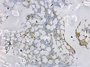 Bone marrow in systemic mastocytosis showing mastocytic infiltration (immunohistochemical study with anti-tryptase antibodies, original magnification ×100).