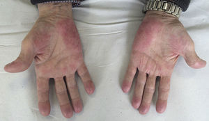 Erythema and mild desquamation on the palms.