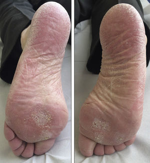 Hyperkeratotic papules on weight-bearing surfaces of the balls of the feet.