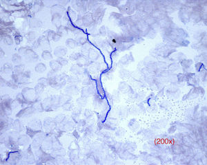 Direct examination of a tinea. The dermatophytes appear as septate and branching filaments with clear, regular hyaline borders that have taken up the blue color from the ink. Original magnification, ×40.