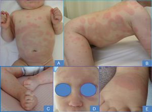 Coalescing annular and archiform plaques with a violaceous center on the trunk (A and B), face (D), and limbs (C and E).