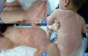 Small urticarial lesions that spread outward leaving an ecchymotic center on the leg and foot (A), anterior aspect of the trunk (B), and posterior aspect of the trunk (C), coalescing until they occupy nearly the entire back.