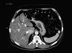 Initial computed tomography staging of a man with primary cutaneous melanoma (stage T3a) on his back. The white arrow indicates the presence of a hypodense space-occupying lesion in the liver parenchyma that was confirmed as being metastatic after resection and histopathology.