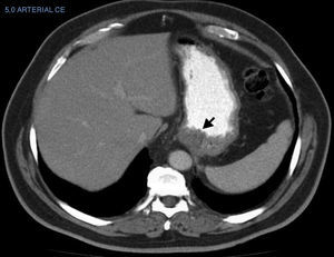 Thickening of the stomach wall observed on a computed tomography scan for baseline staging ordered for a man with superficial melanoma (stage T1a) on the left lower extremity.