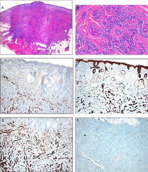 Histology. A, Low magnification showing a dense, nonencapsulated infiltrate that reaches the muscle layer. Hematoxylin-eosin (H&E), original magnification ×4. B, Detail of the fibrous stroma, with the presence of glandular lumens and cells grouped in cords. Note the squamous differentiation. H&E, original magnification ×40. C, Immunohistochemistry. Positivity for low molecular weight cytokeratins. Original magnification ×10. D, Immunohistochemistry. Positivity for high molecular weight cytokeratins. Original magnification ×10. E, Immunohistochemistry. Positivity for CD10. Original magnification, ×10. F, Immunohistochemistry. Stain for Ki67. Note the low cell proliferation index. Original magnification, ×10.