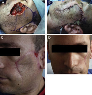 Clinical images. A, Design of the rotation flap on the cheek. B, Result immediately after surgery. Rotation flap and Burow graft. C, Lateral view. Result 45 days after surgery. D, Frontal view. Result 45 days after surgery.