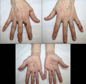 Vesiculobullous lesions with a bloodstained content on the dorsum and palms of the hands, with some areas of erosion and desquamating erythematous plaques on the wrists.